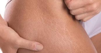 9 Hal Yang Wajib Dilakukan Untuk Menghilangkan <i>Stretch Mark</i>