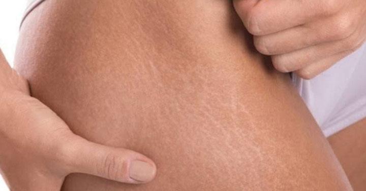 Yang Dilakukan Untuk Menghilangkan Stretch Mark