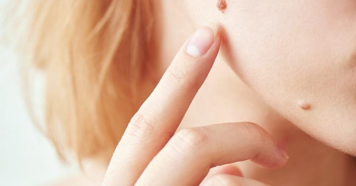 atasi skin tag dengan cuka apel