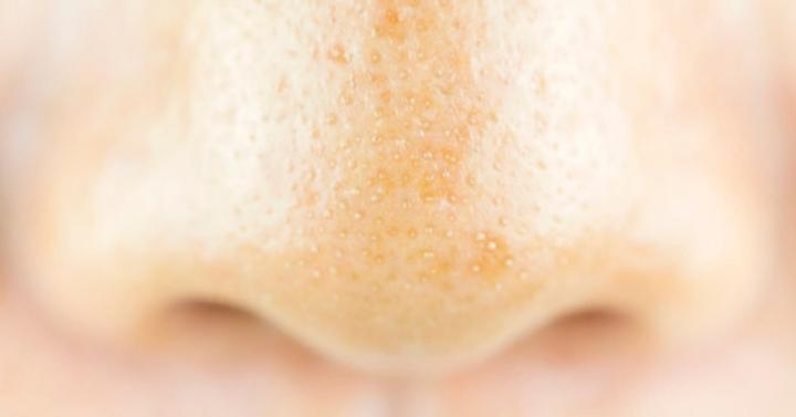 blackheads atau komedo lenyap dengan cuka apel