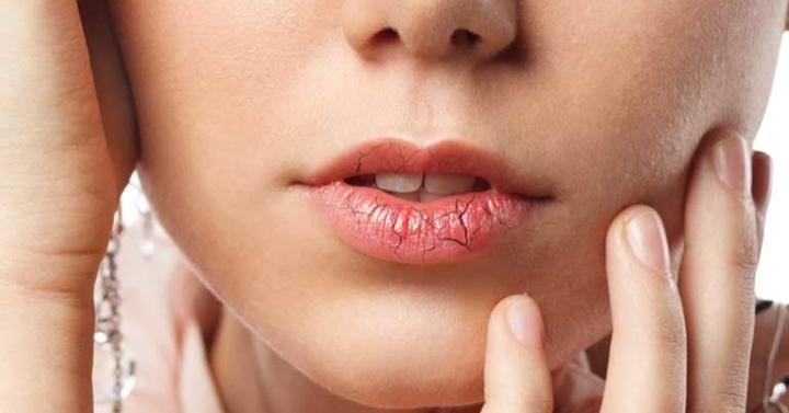 Cara Mengatasi Bibir Kering Dan Mengelupas
