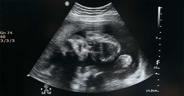 tahan perkembangan janin bayi